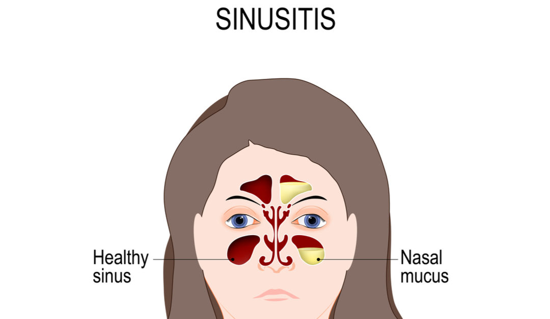 What Causes Sinusitis?